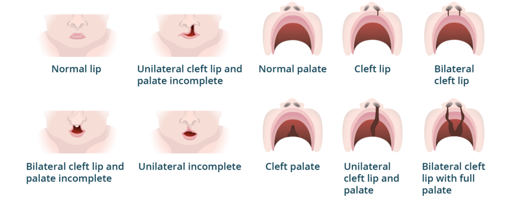 Medical chart illustrating different types of cleft lip and cleft palate variations, including normal, unilateral, and bilateral conditions.
